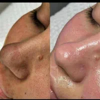 پاکسازی و فشیال صورت ویژه  بانوان و آقایان|خدمات آرایشگری و زیبایی|اردکان, |دیوار