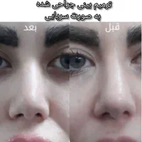 ژل بوتاکس ۳۹۰/ فیلربینی زیرچشم/لیفت صورت شقیقه/نخ|خدمات آرایشگری و زیبایی|تهران, فدک|دیوار