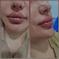 ژل و بوتاکس|خدمات آرایشگری و زیبایی|مسجد سلیمان, |دیوار