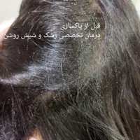 درمان سریع و گیاهی رشک و شپش بدون مواد شیمیایی|خدمات آرایشگری و زیبایی|یزد, |دیوار