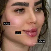 ژل بوتاکس تضمینی