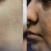 لیزر اربیوم جای جوش،بلفاروپلاستی،اسکار و لک