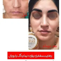 درمان لک پوستی(کک و مک، لک بارداری و جای جوش)|آرایشی، بهداشتی، درمانی|شوشتر, |دیوار