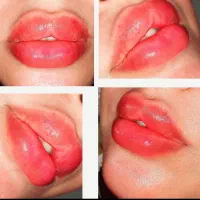 ژل بوتاکس،برداشتن خال پاککردن تاتو،فیلرآنزیم اموزش