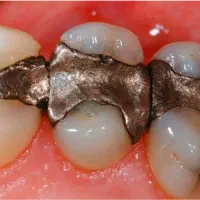 ضایعات آمالگام