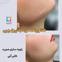 کاشت مو و ابرو / بوتاکس / چربی  ژل /کلینیک /زیبایی