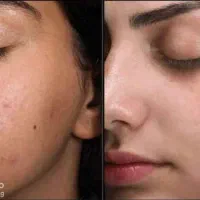 پاکسازی صورت