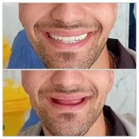 دندان مصنوعی(بدون ۱ریال سود/۳ الی۸ماهه/پذیرش بیمه)