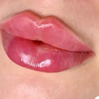 تزریق ژل لب بدون درد تزریق ژل گونه شقیقه چانه