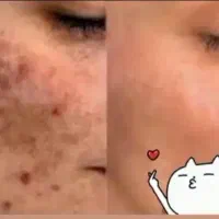 برداشتن خال های گوشتی و انجام تتو بدن و فیبروز|خدمات آرایشگری و زیبایی|ارومیه, |دیوار