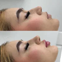 آنزیم ترکیبی بینی، لیفت بینی ژل کانتور صورت لب مزو|خدمات آرایشگری و زیبایی|تهران, سعادت‌آباد|دیوار