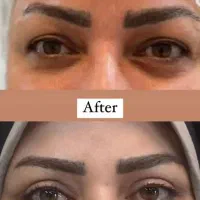 جراحی زیبایی / بلفارو پلاستی / عمل پلک / بلفارو