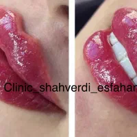 ژل وبوتاکس طرح ویژه برای افرادباشرایط مالی خاص مطب