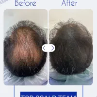 میکرو اسکالپ مکمل کاشت مو|خدمات آرایشگری و زیبایی|یاسوج, |دیوار