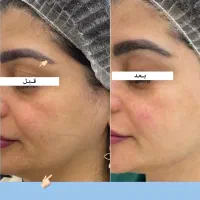 جوانسازی پوست با ترکیب قدرتمند هایفوتراپی + PRP|خدمات آرایشگری و زیبایی|تهران, هفت حوض|دیوار