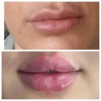 افر‌ویژه فیلر بدن و صورت و بوتاکس و هایفو