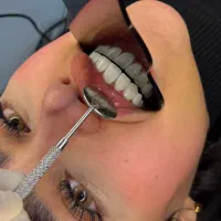 فقط با۵تومن پیش پرداخت دندوناتو کامپوزیت کن