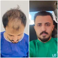 کاشت مو VIP بابیشترین رضایت و بالاترین سابقه کشوری