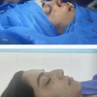 عمل زیبایی بینی در مازندران|خدمات آرایشگری و زیبایی|قائمشهر, |دیوار