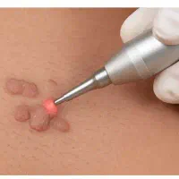 حذف زگیل فقط بانوان