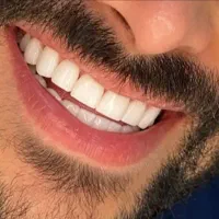 جشنواره کامپوزیت با تخفیف ۳۰درصدی