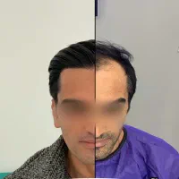کاشت مو و ریش با ضمانت|خدمات آرایشگری و زیبایی|شیراز, قصرالدشت|دیوار