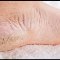 درمان ترک پا