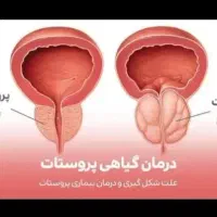 بهبود پروستات