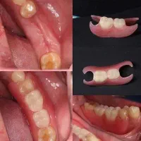 دندان مصنوعی قالب گیری در منزل|خدمات آرایشگری و زیبایی|کرج, کوی امامیه|دیوار