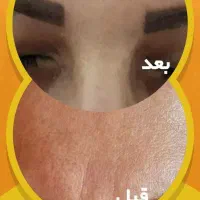 کرم بوتاکس حرفه ای آذین|آرایشی، بهداشتی، درمانی|شیراز, جانبازان|دیوار