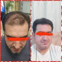 کاشت مو به روش شیرازی