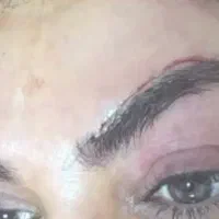 بلفاروپلاستی   ساکشن کاشت ابرو سانترال