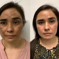 کرم سفیدکننده پوست وضدلک قوی گلدن کویین|آرایشی، بهداشتی، درمانی|مرودشت, مسجد رسول|دیوار