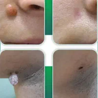 حذف خال، کک‌ومک،میخچه، زگیل و غیره با کمترین قیمت
