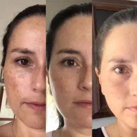 از بین بردن انواع لک صورت