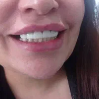 تخفیفات ویژه کامپوزیت در درمانگاه تخصصی یاسوج|خدمات آرایشگری و زیبایی|یاسوج, |دیوار