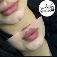 کلینیک تزریق ژل،بوتاکس،لیزر هایفو فشیال خال نخ|خدمات آرایشگری و زیبایی|تهران, نیروی هوایی (پیروزی)|دیوار