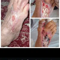 پای دیابتی راقطع نکنید.درمان میشود.|فعالیت داوطلبانه|ایلام, |دیوار