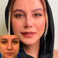 تخفیف شگفت انگیز عمل بینی
