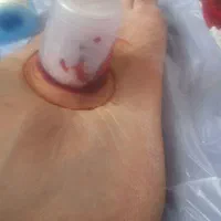 حجامت و بادکش و فصد