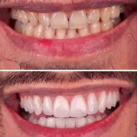 کامپوزیت.لمینت.پروتز.دست دندان|خدمات آرایشگری و زیبایی|تهران, مجیدیه|دیوار