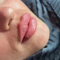 خدمات فیلر صورت