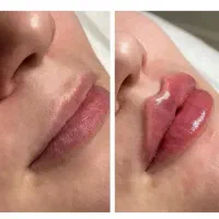 تخفیف ویژه فیلربوتاکس prp لیزرمزو خال کلینیک ماهور