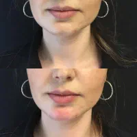 کلینیک زیبایی جراحی ژل بوتاکس غبغب فیلر لیزر مزو|خدمات آرایشگری و زیبایی|کرج, مهرویلا جنوبی|دیوار