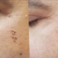 معالجه ی صحیح و ریشه ای زگیل تناسلی