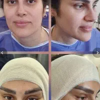 مینی لیفت شقیقه گونه اندولیفت ابروبلفارو|خدمات زیبایی و سلامت|تهران, میدان ولیعصر|دیوار