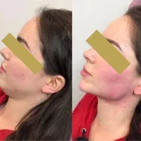 فیلر و بوتاکس نچرال و بدون عارضه