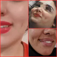ژل بوتاکس چال لپ فیلربیکینی مزوتراپی پیرسینگ|خدمات آرایشگری و زیبایی|اسلام‌شهر, زرافشان|دیوار