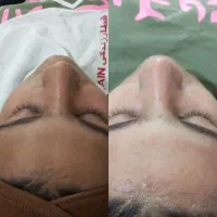 فیشیال و پاکسازی پوست|خدمات آرایشگری و زیبایی|مشهد, رسالت|دیوار