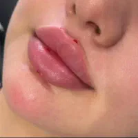 تخفیف فوق العاده خدمات ژل و بوتاکس در مطب